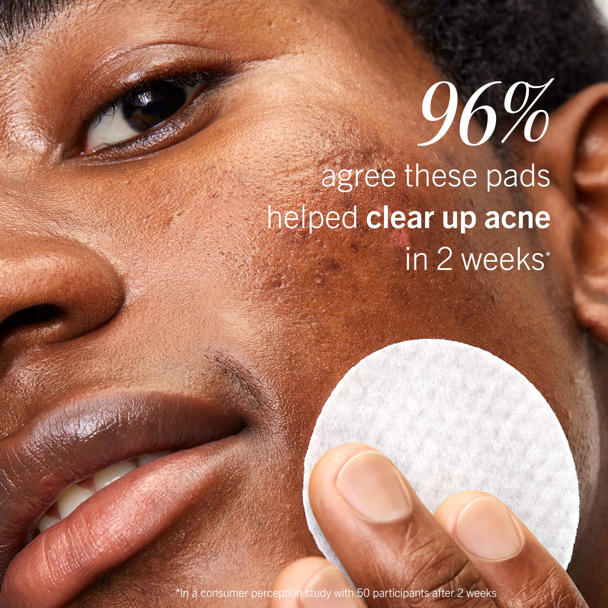 First Aid Beauty Acne Pads being used as part of a skincare routine.