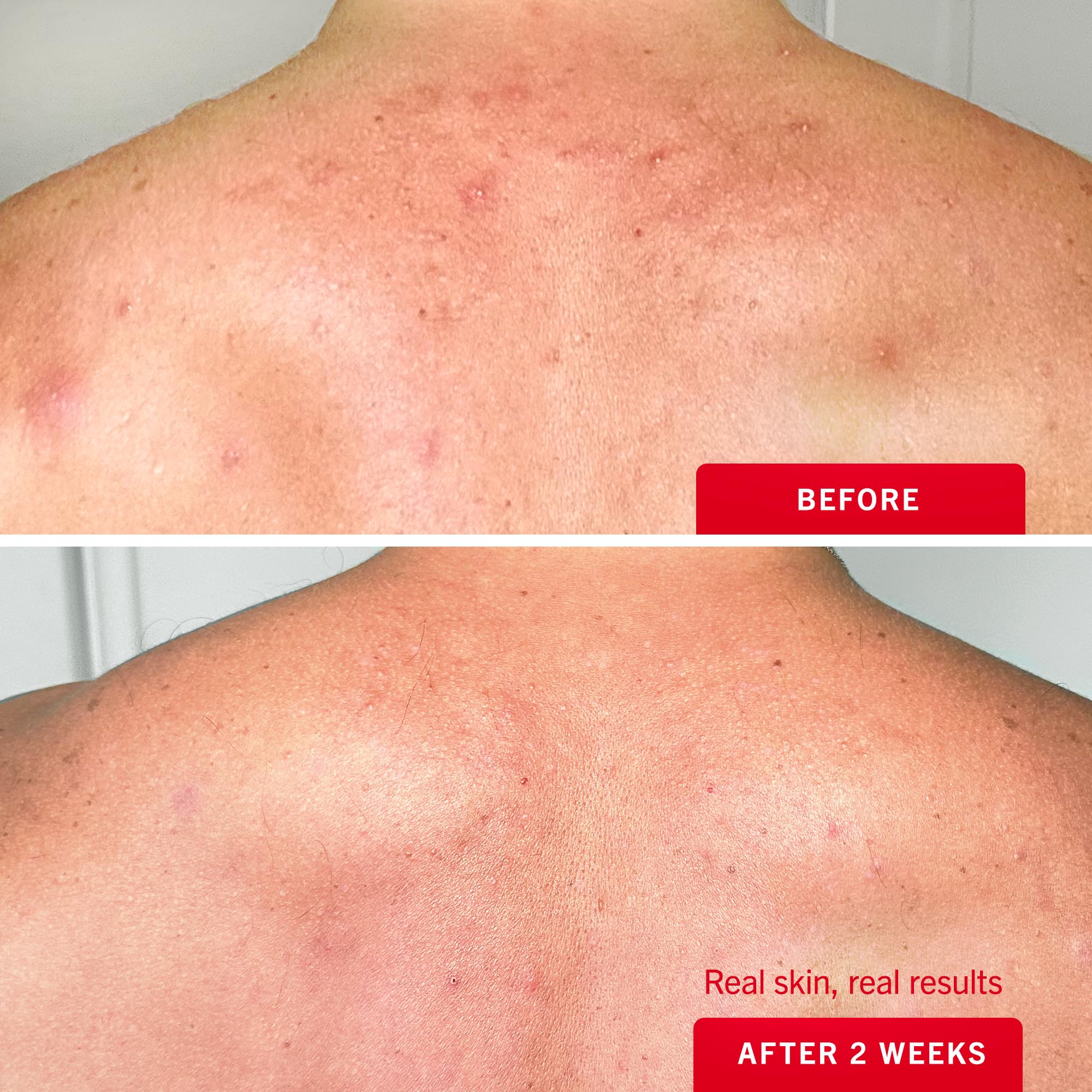 Hydrating glycerin helps maintain moisture while addressing surface blemishes.