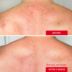 Hydrating glycerin helps maintain moisture while addressing surface blemishes.
