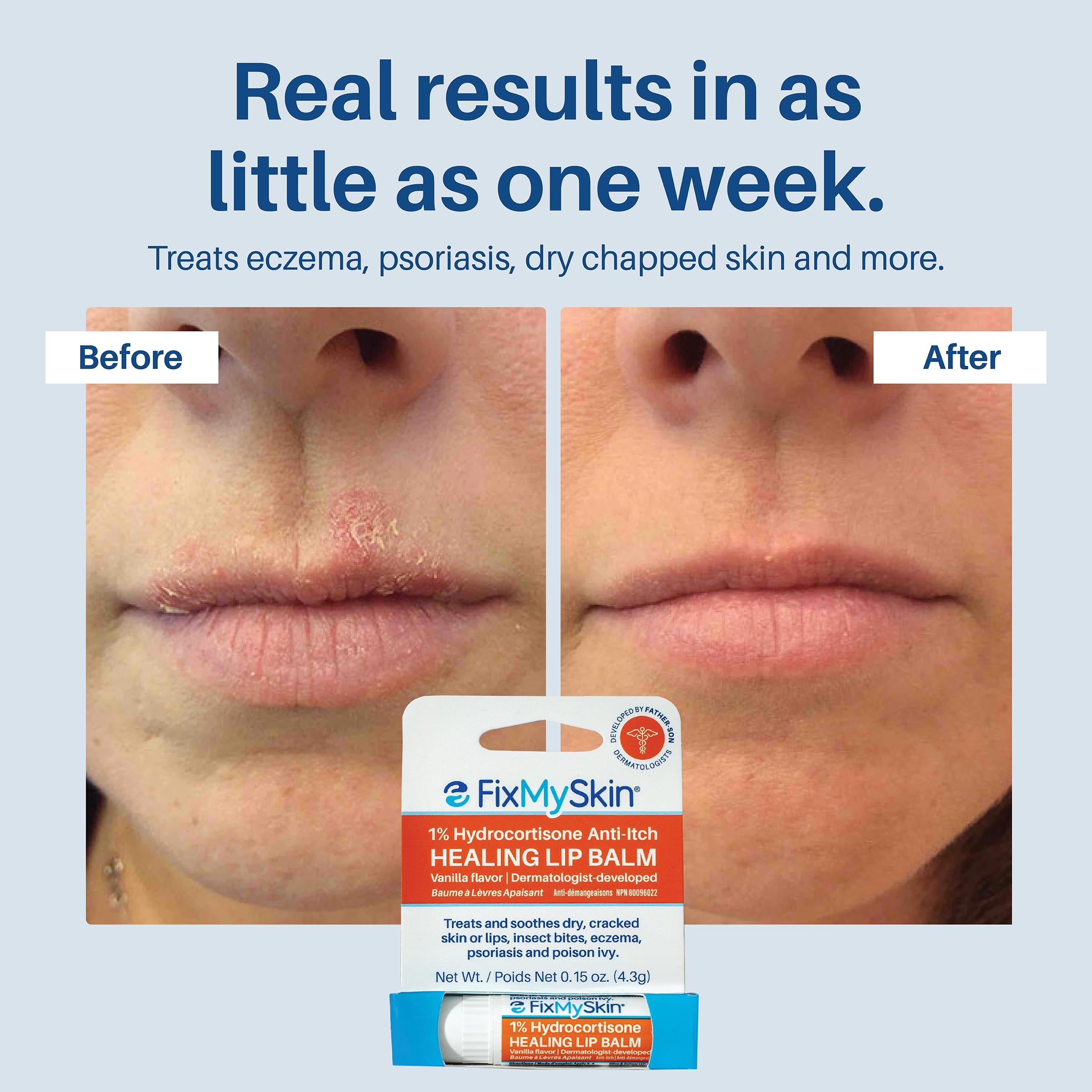 Insect bite and eczema relief with FixMySkin lip balm.
