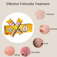 Folliculitis Cream neck armpits application eases irritation for daily comfort.