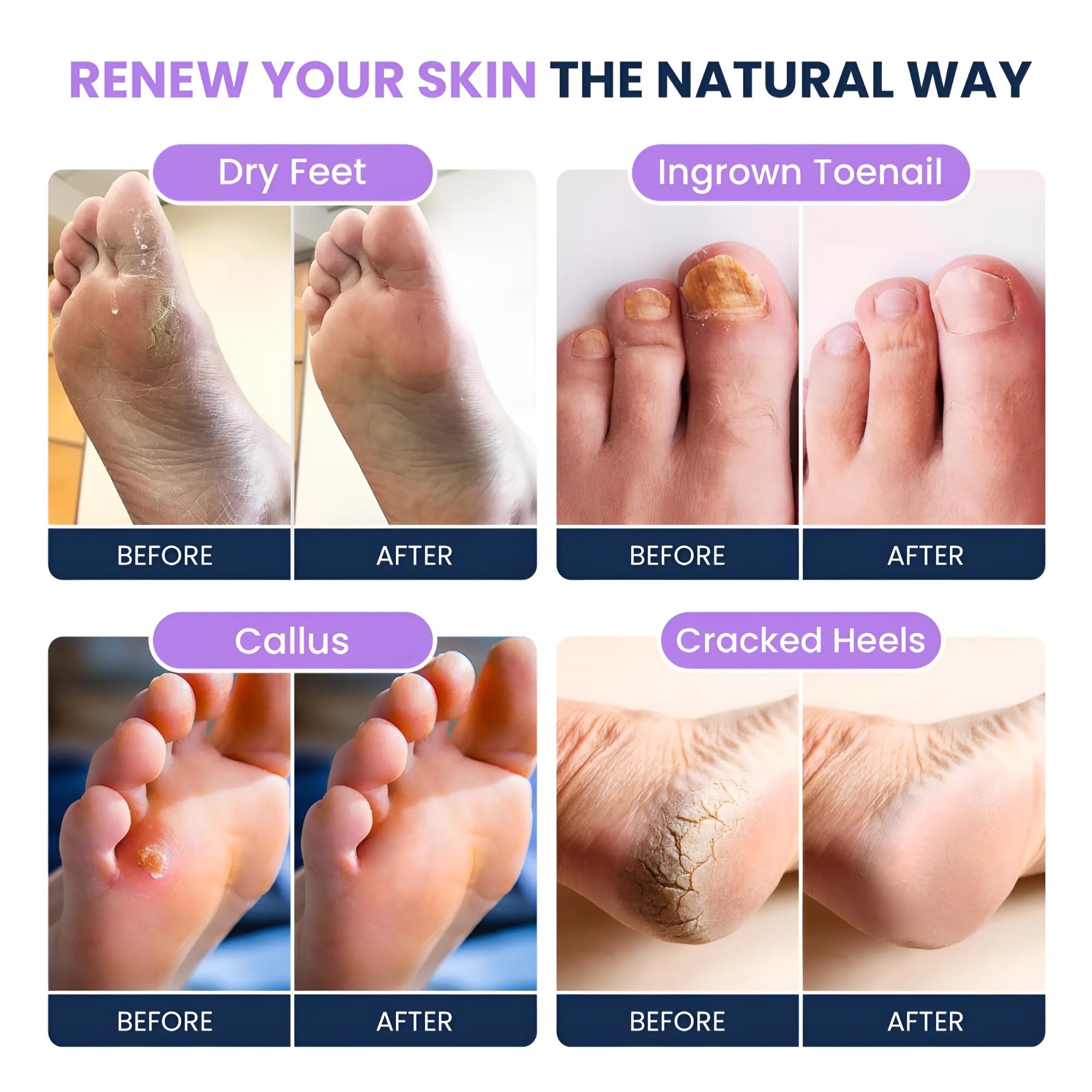 FOOT CURE dry-cracked-feet hydration soak restores skin comfort
