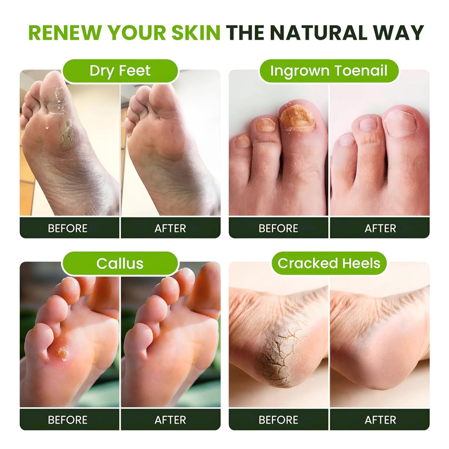 Foot Cure Tea Tree Oil Foot Soak relaxing spa-like setup for home care
