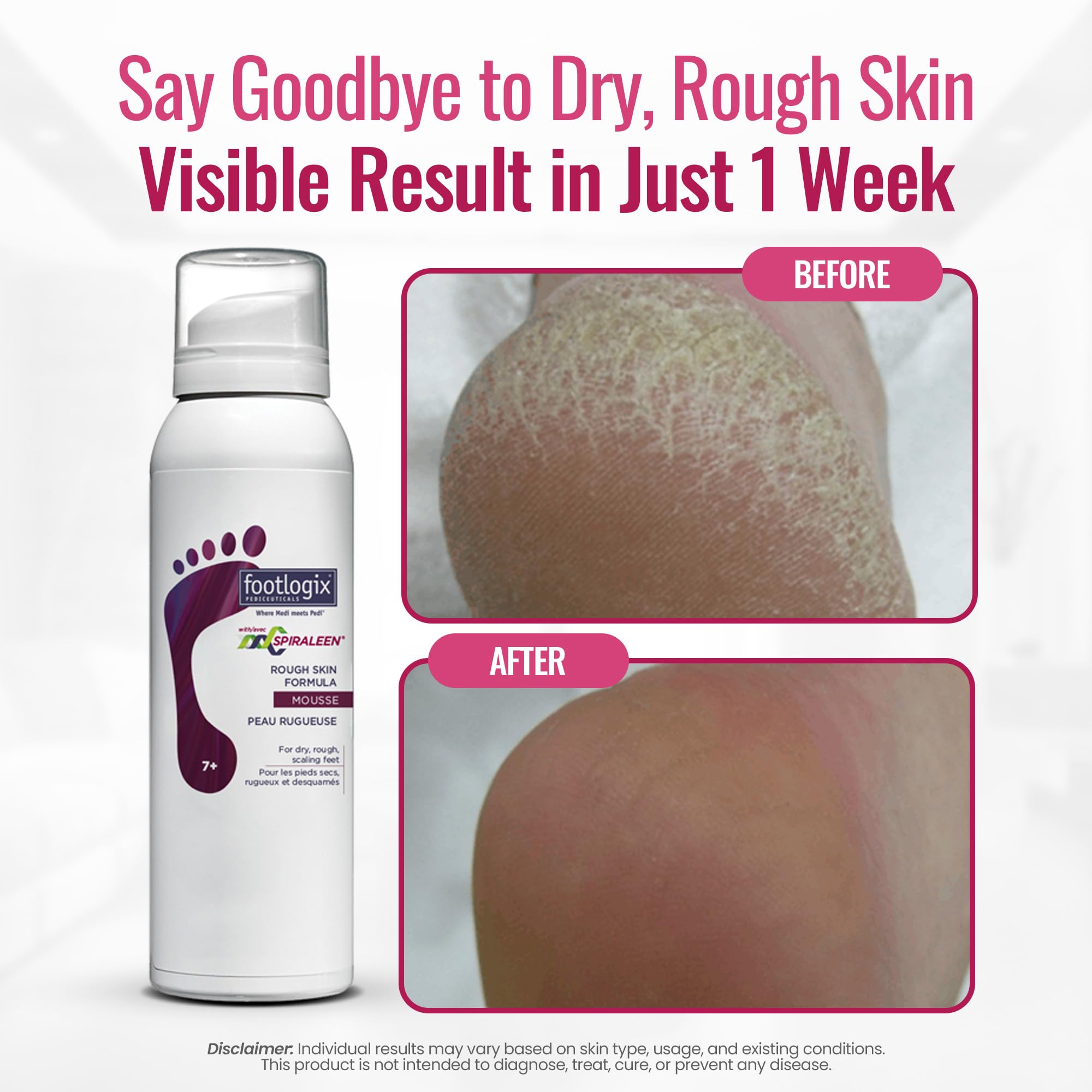 Footlogix mousse on heel demonstrates targeted care for dry, cracked skin.