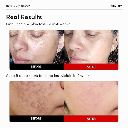 FRANKLY Retinol cream with ceramides and ginseng for hydration.