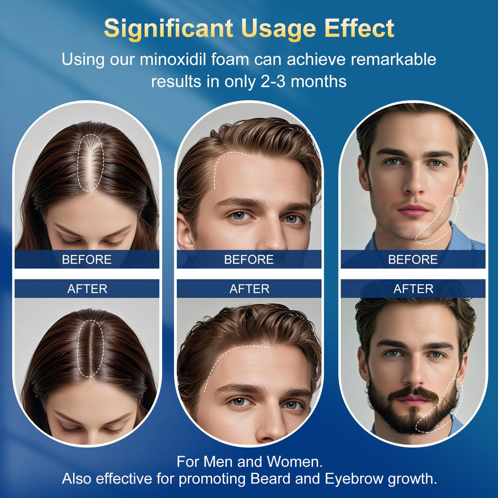 Frnoip Minoxidil Foam with biotin infusion for healthier hair support.
