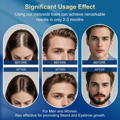 Frnoip Minoxidil Foam with biotin infusion for healthier hair support.
