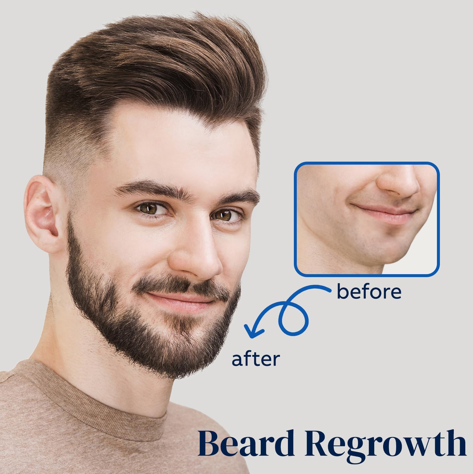 FUZYAT Minoxidil-scalp application targeting thinning areas.