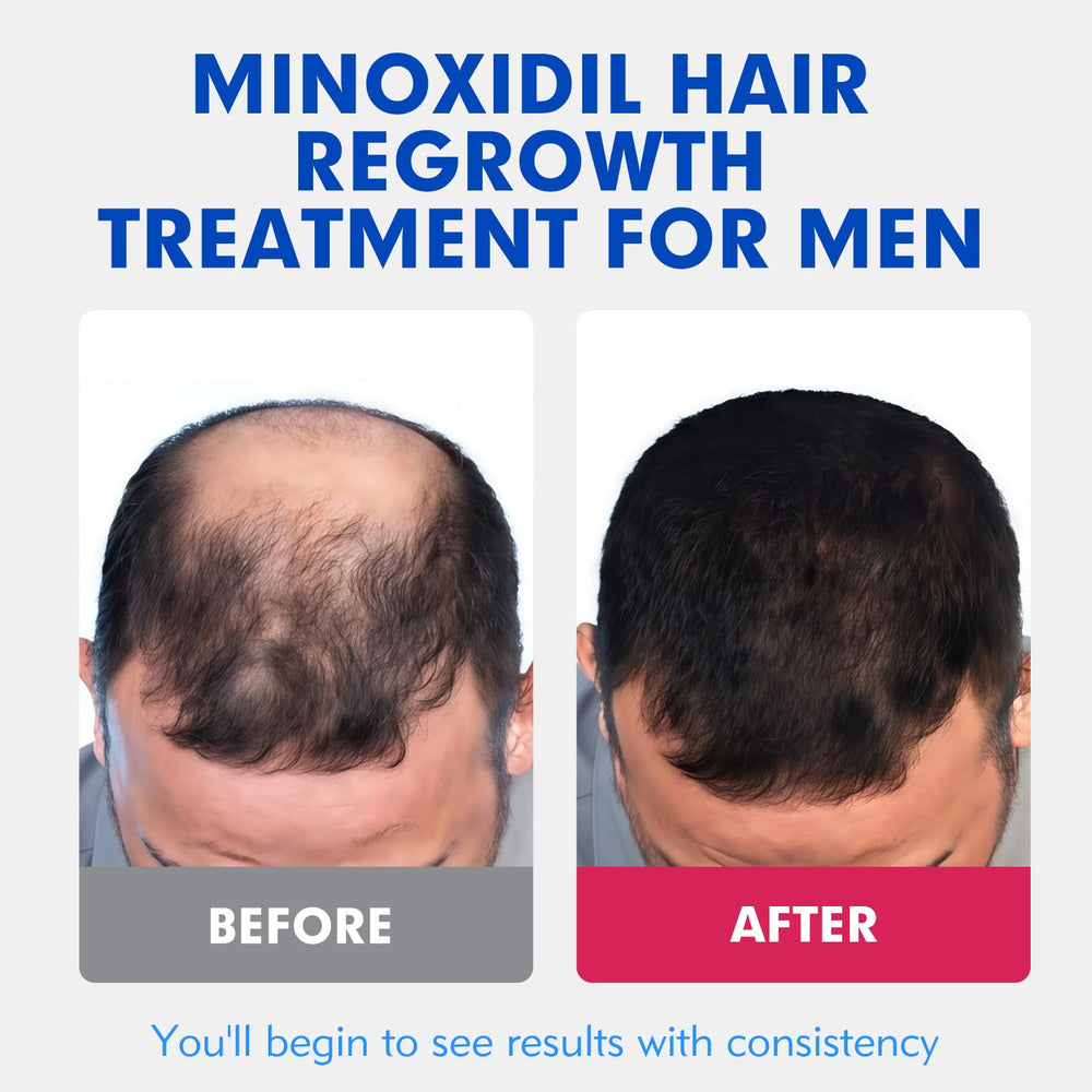 Fyntikal minoxidil bottle pour showing convenient twice-daily use