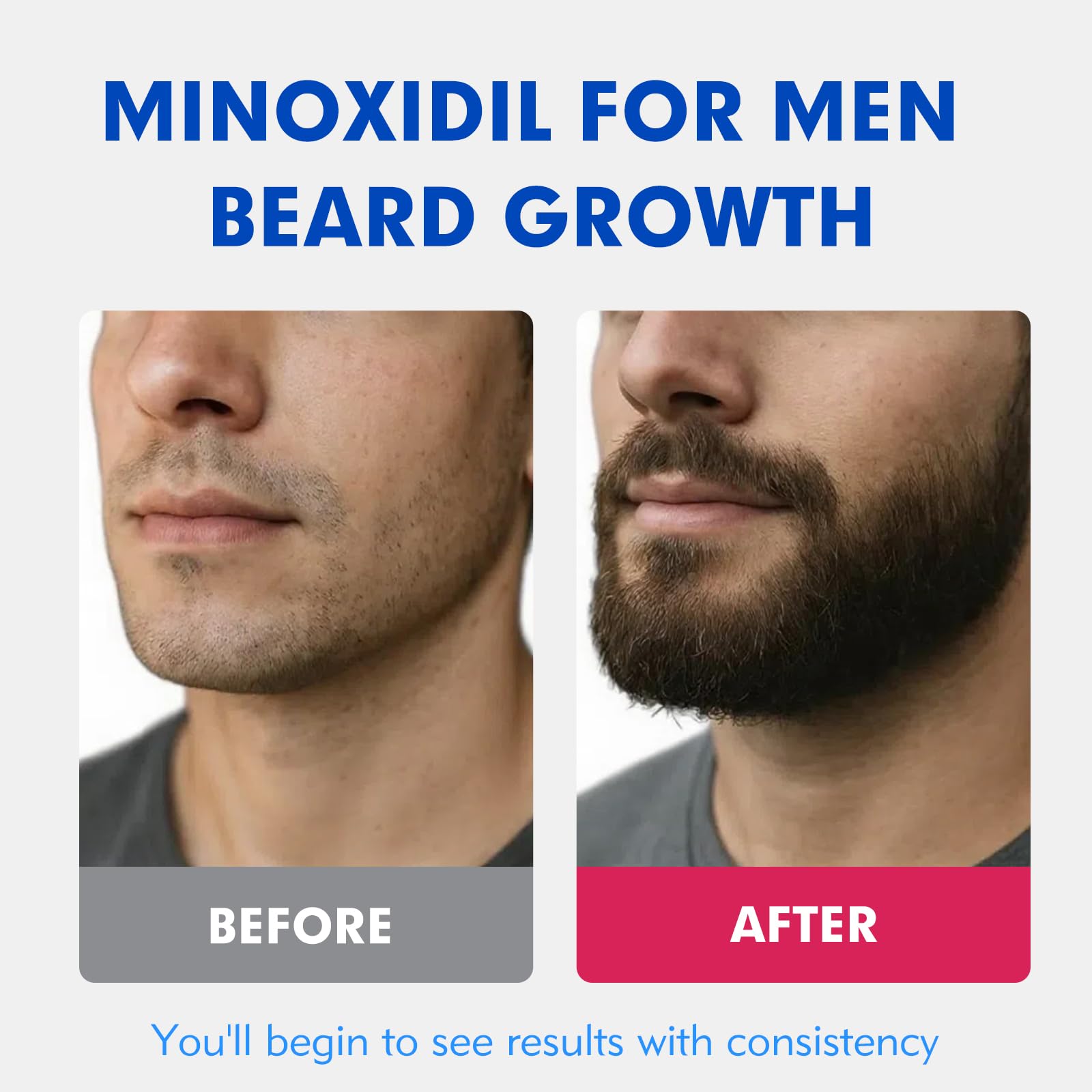 Fyntikal minoxidil dropper application for precise scalp targeting