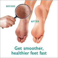 GILDEN TREE 42% Urea Gel helps soften dry skin on feet.