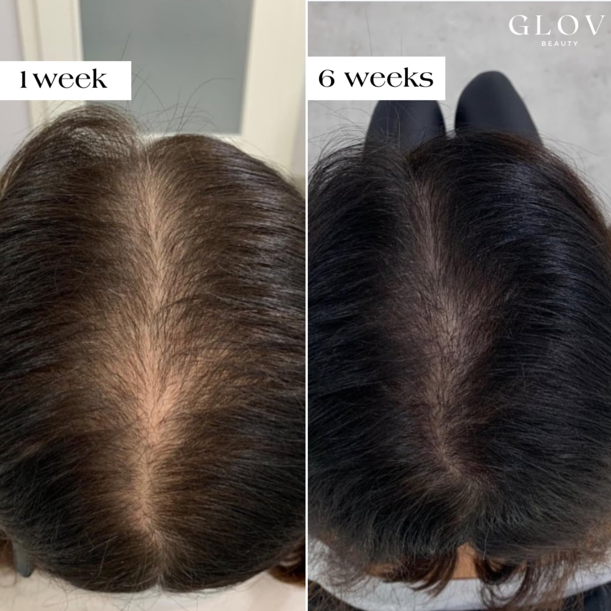 Glov Beauty gold derma stamp head in use for gentle micro-needling on the scalp.