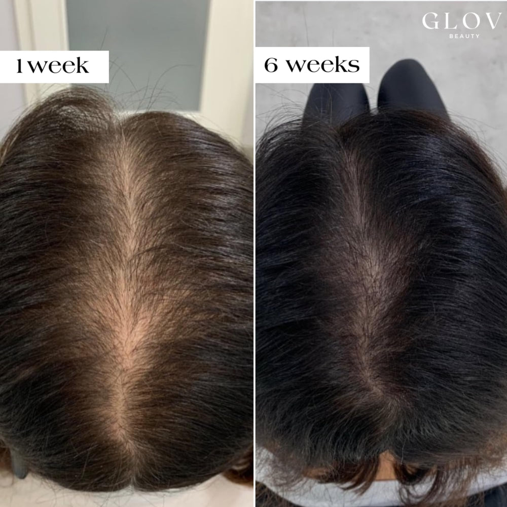 Glov Beauty gold derma stamp head in use for gentle micro-needling on the scalp.