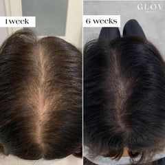 Glov Beauty gold derma stamp head in use for gentle micro-needling on the scalp.