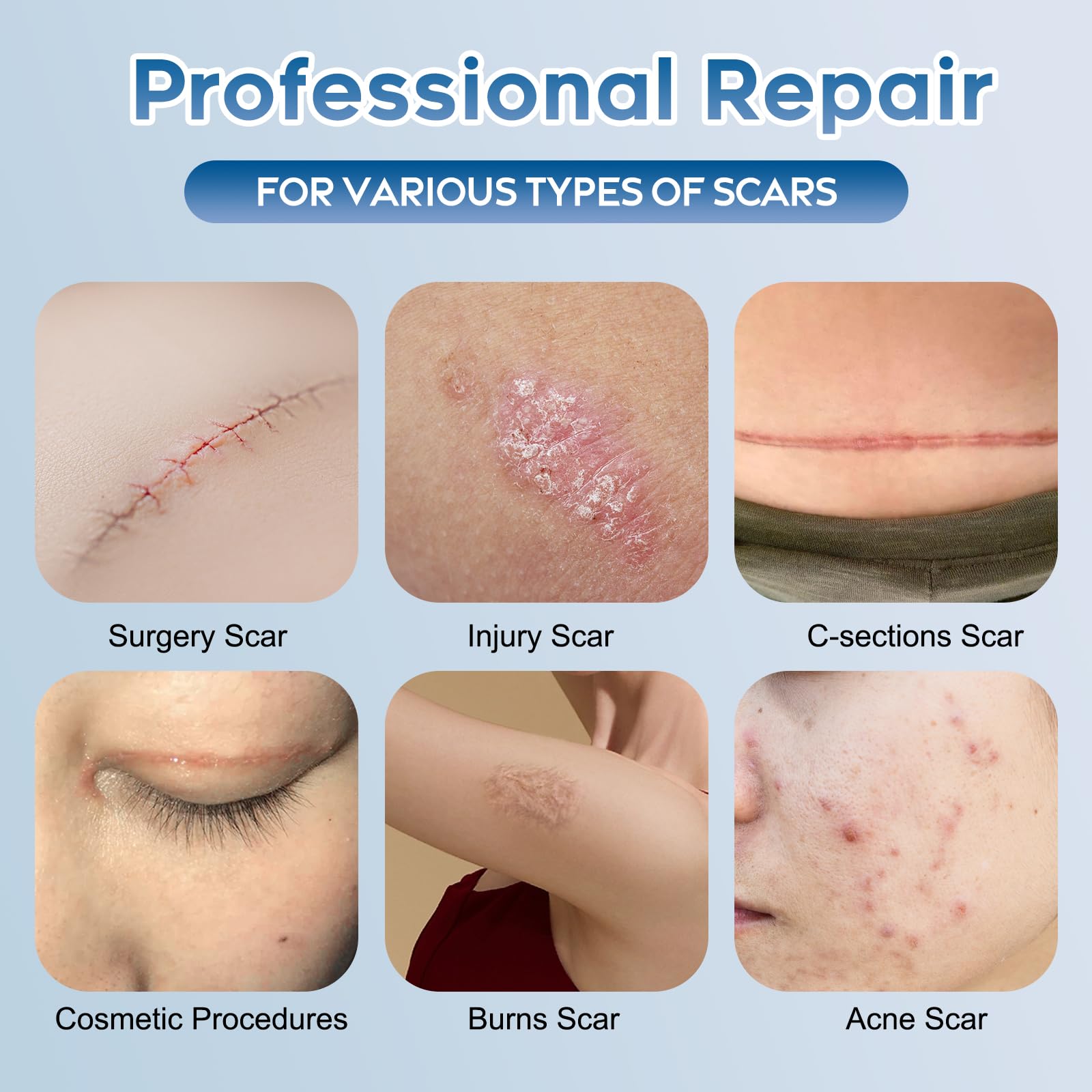 Glowor scar gel on the body to soften scar texture