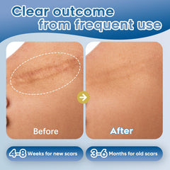 Before and after view with Glowor scar gel on skin