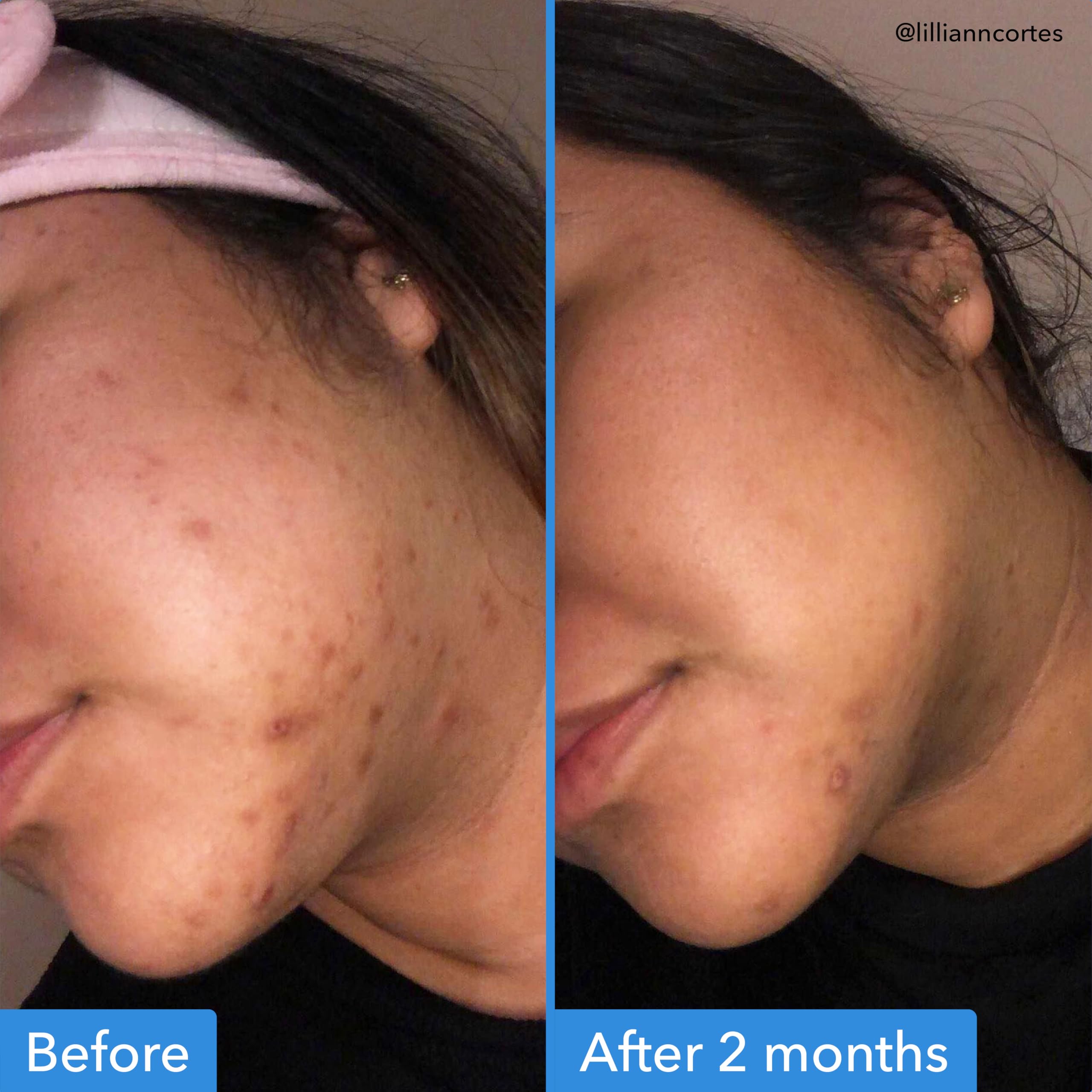 Good Molecules Discoloration Correcting Serum Pack 2 dropper closeup enables precise application for targeted spot care.