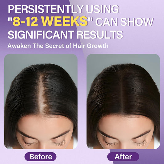 Greoay minoxidil foam pump demonstrates quick application to thinning areas