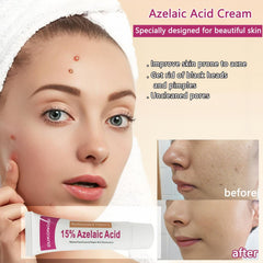 gzchaox azelaic acid cream suitable for all skin types