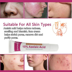 gzchaox azelaic acid cream reducing redness and blemishes