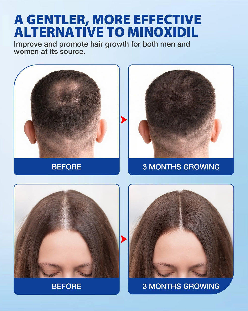 HACIRJNG Rosemary, Redensyl and Anagain ingredients for targeted scalp care