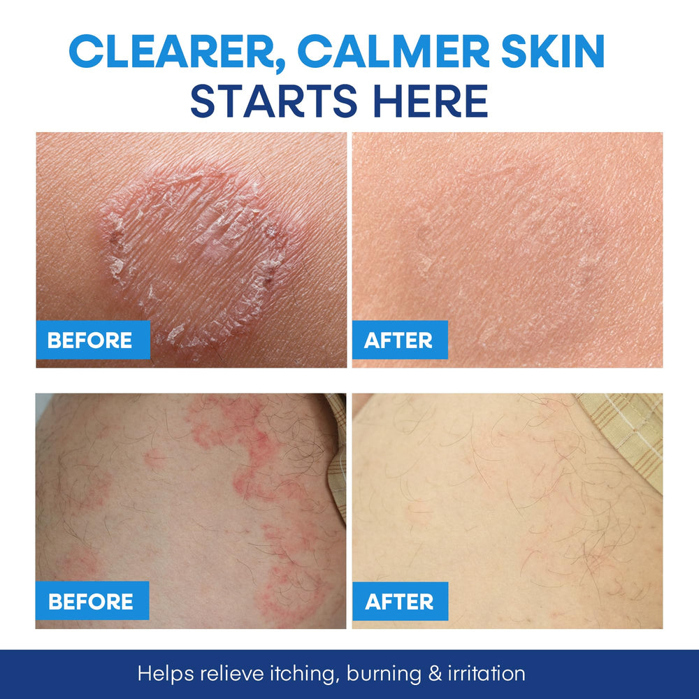 Hermon Antifungal Body Wash foamy-lather demonstrates deep-cleanse action