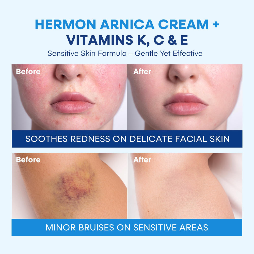 Hermon Arnica Bruise Cream swirl shows creamy consistency