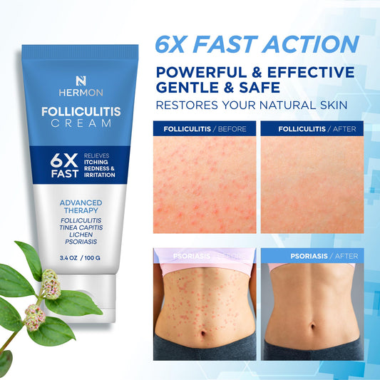 Close-up of Hermon Folliculitis Cream label with gentle formula.
