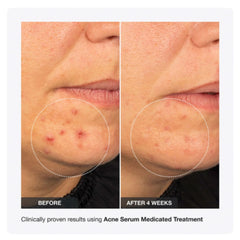 Innbeauty Project Acne Serum label close-up noting ceramides and emollients