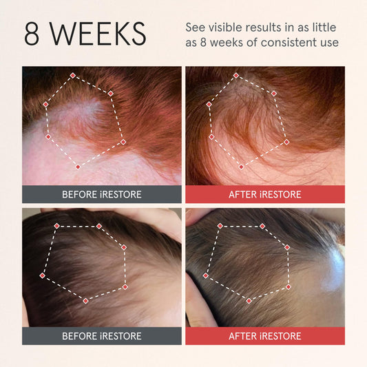 iRestore Scalp Serum bottle closeup highlights premium formula for nourishing scalp health.
