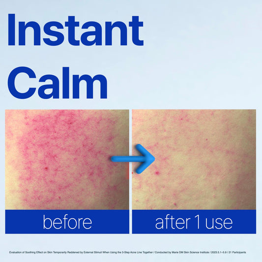ISOI ACNI Dr. 1st Speedy Gel Cream texture swatch showing cooling relief.