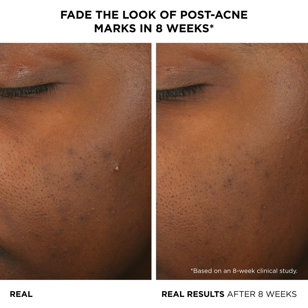 IT Cosmetics Bye Bye Breakout serum dropper releasing formula for targeted care