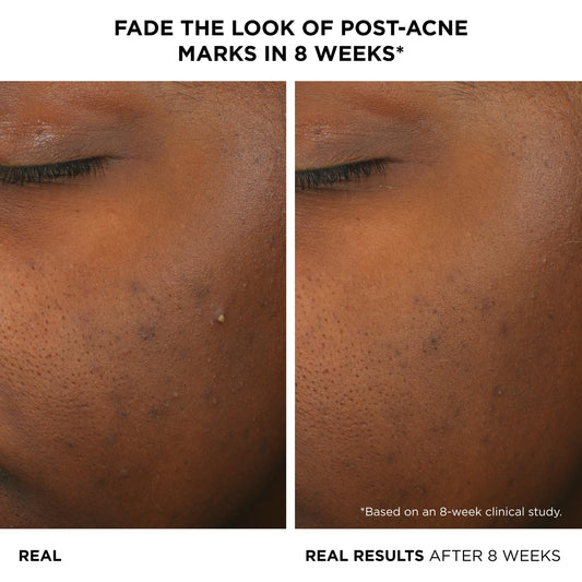 IT Cosmetics Bye Bye Breakout serum dropper releasing formula for targeted care
