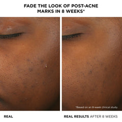 IT Cosmetics Bye Bye Breakout serum dropper releasing formula for targeted care