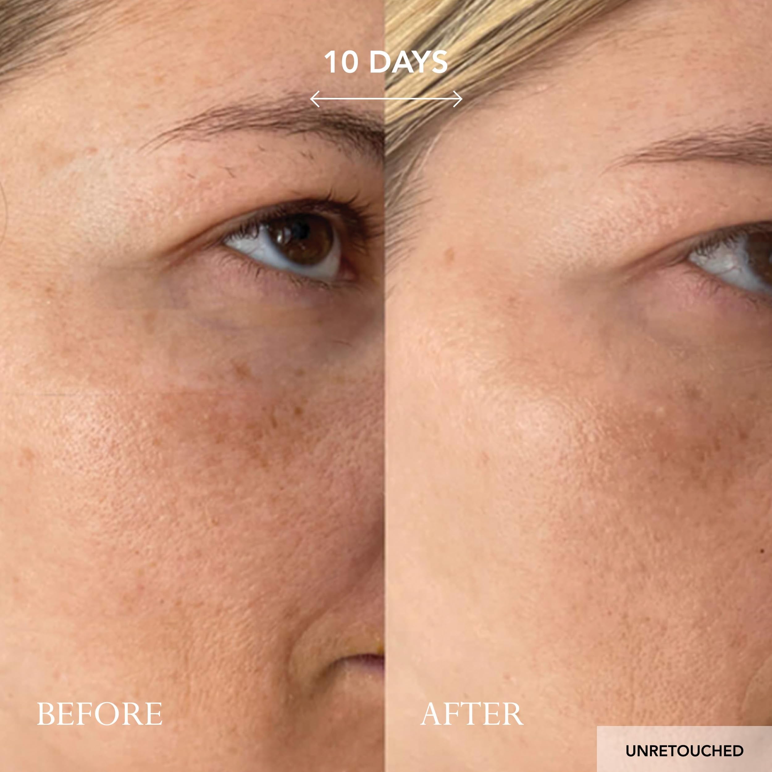 KAT BURKI texture zoom highlighting improved skin elasticity.