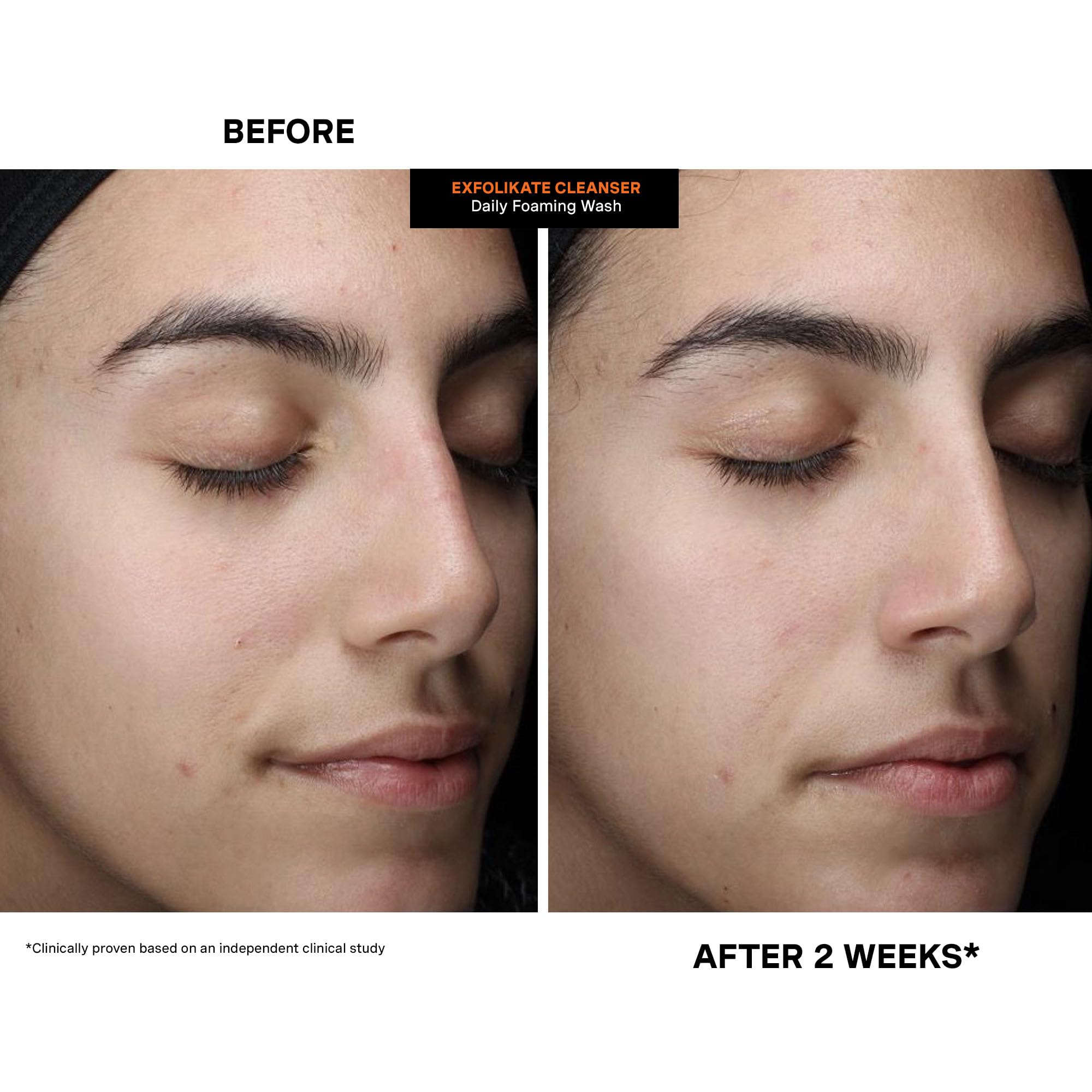 Soft skin close-up after using Exfolikate Cleanser.