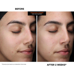 Soft skin close-up after using Exfolikate Cleanser.