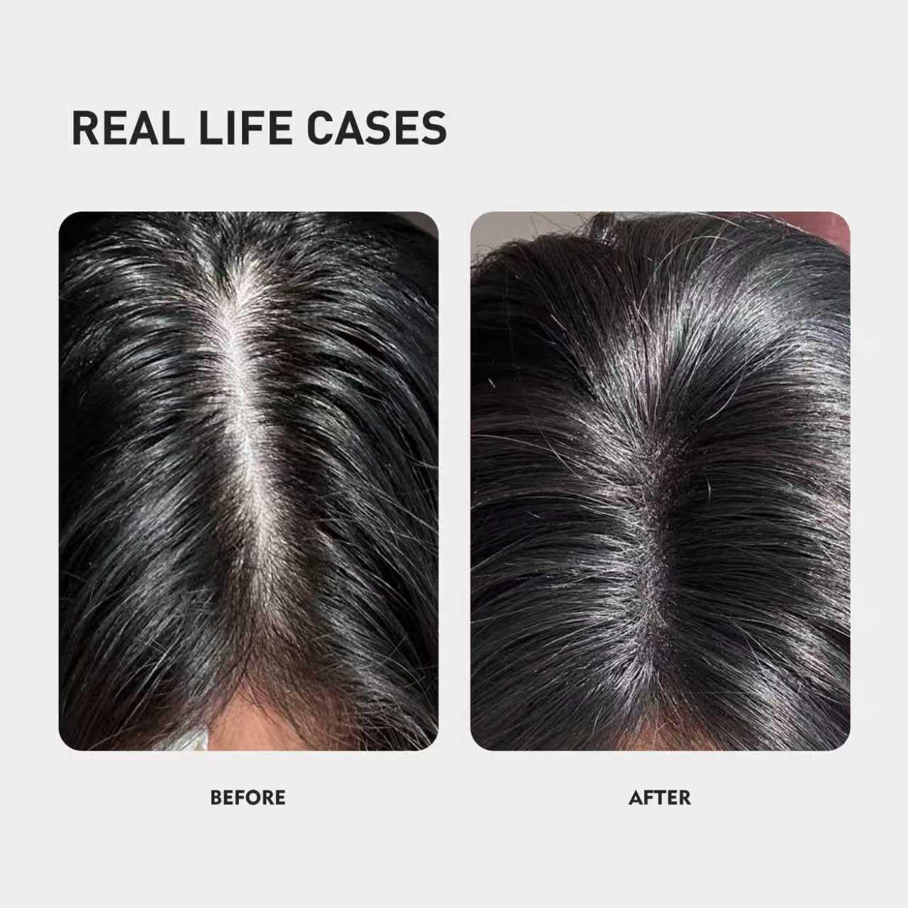 KINTOR 0.5% KX-826 spray action demonstrates easy scalp targeting and application
