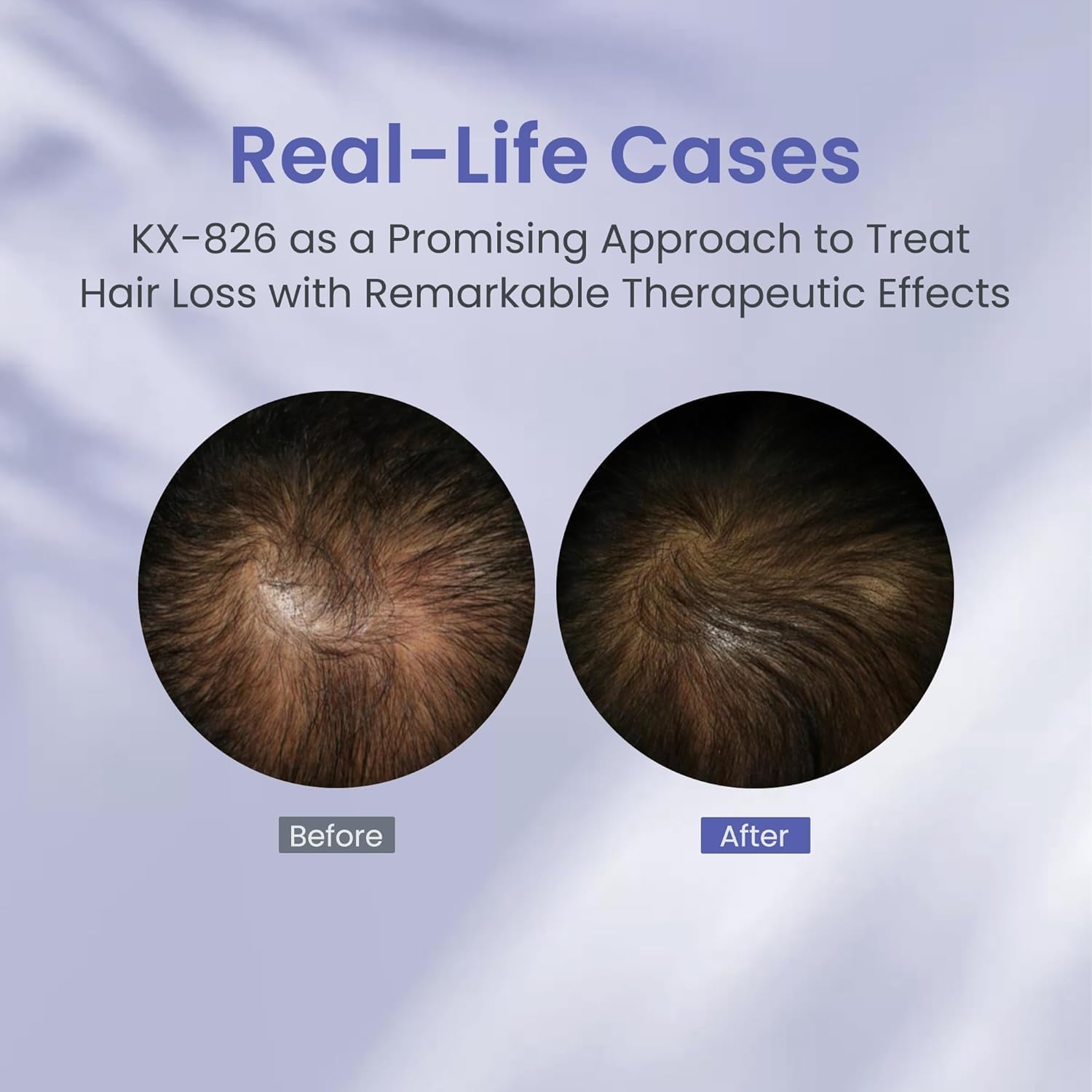 KINTOR KX-826 uses mild ingredients to reduce irritation