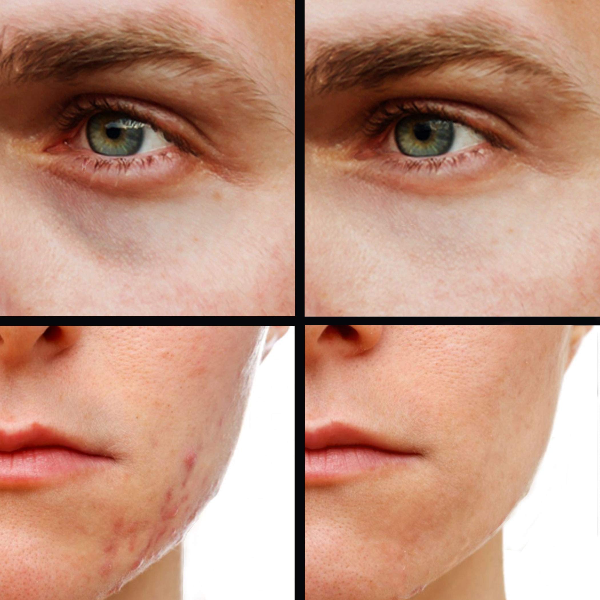 Kode Mens Concealer hides acne scars and blemishes with precise layering.