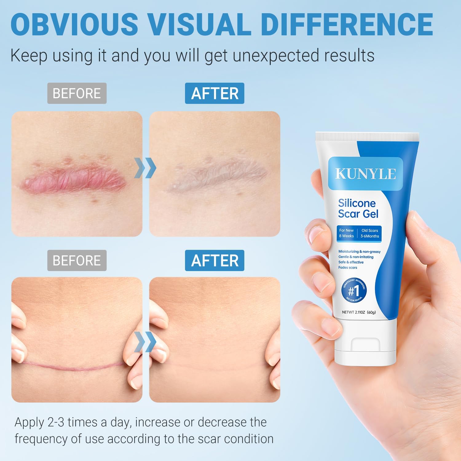 Applying Kunyle scar gel on a scar for easy massage.