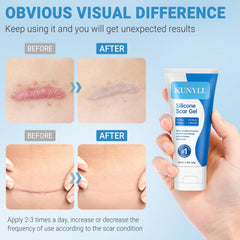 Applying Kunyle scar gel on a scar for easy massage.