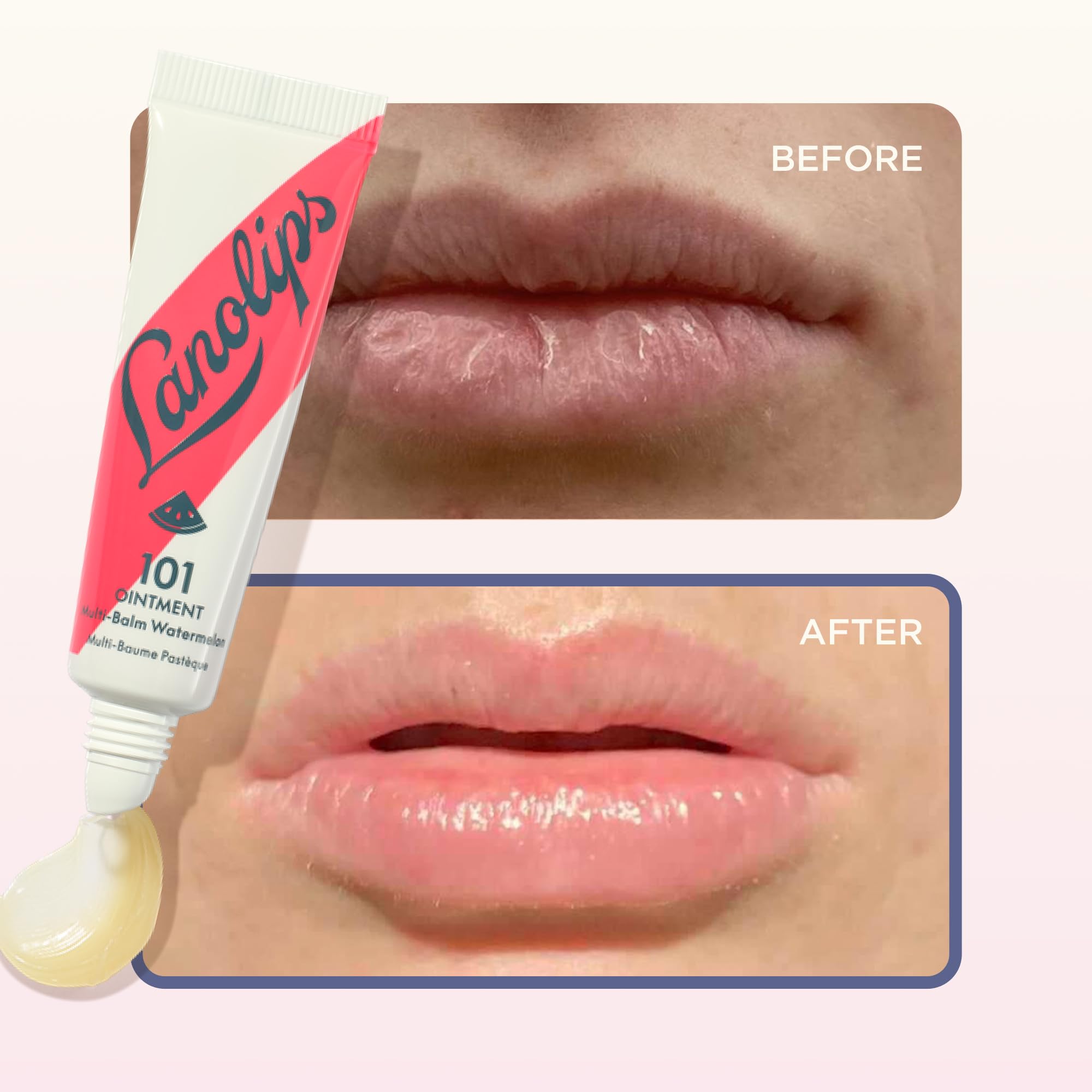 Lanolips 101 Ointment Watermelon dry patches visibly softened.