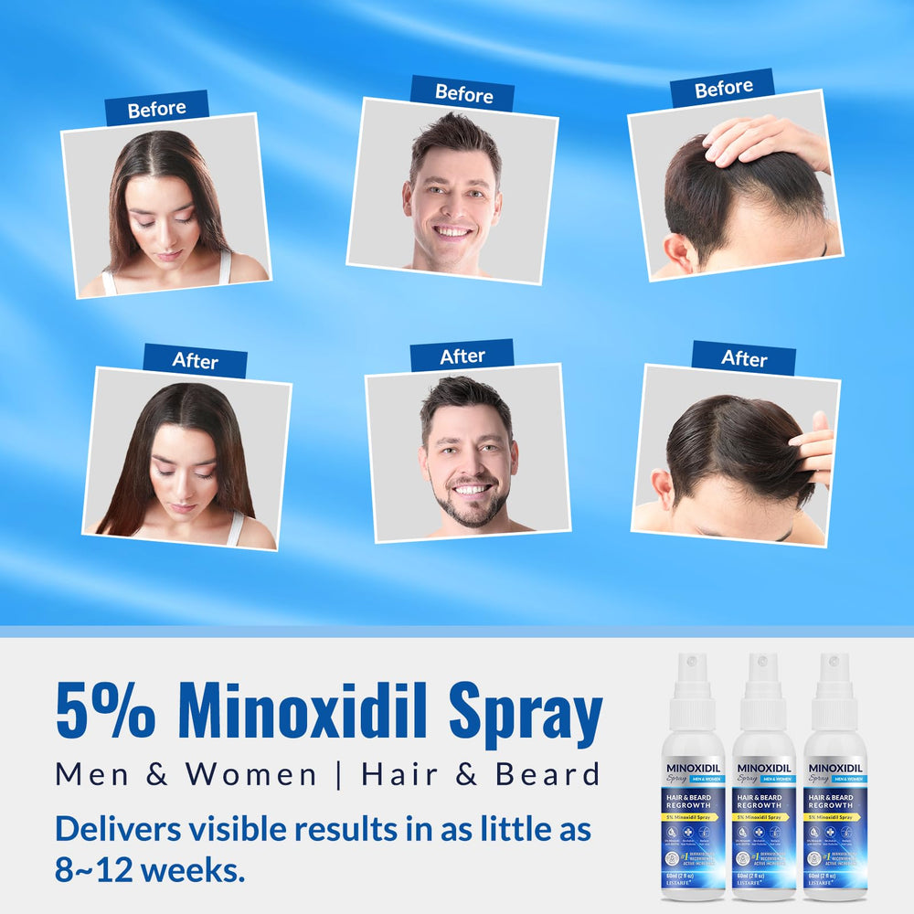 Listarfe 5% Minoxidil spray for women hair growth supports regrowth