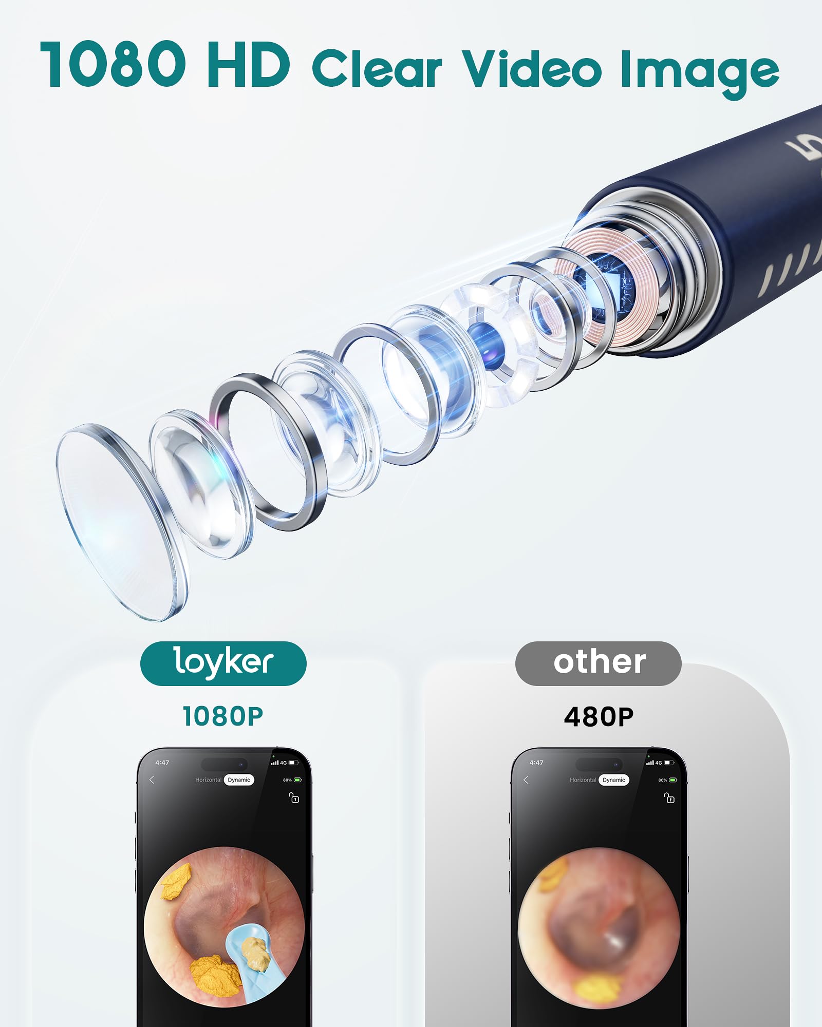 Loyker 6 LED light illuminates the canal for precise removal.