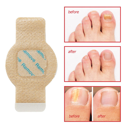 LTQXGT Extra-strength Nail Patches applied to mend cracks and strengthen nails