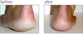 Luxuriant Cracked Heel Repair solid-application tube for targeted heel treatment.