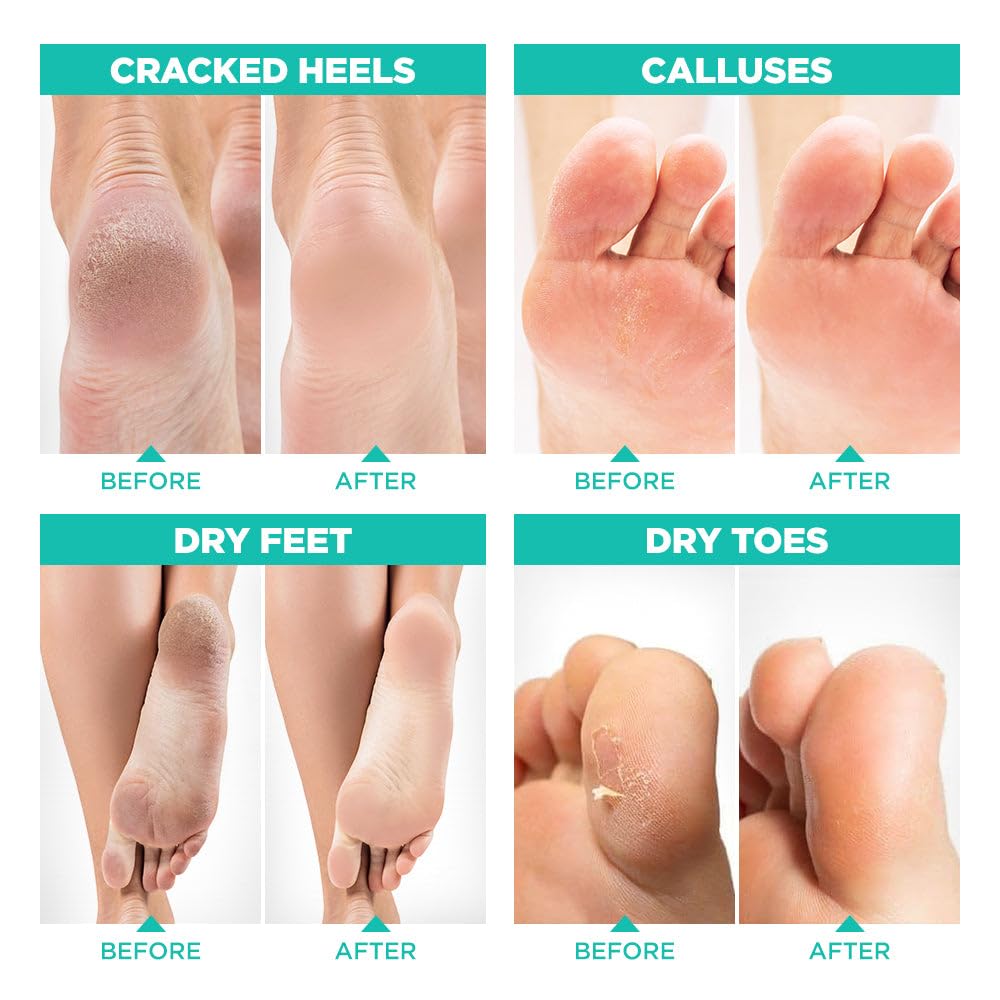 LV LAVINSO soft feet after treatment