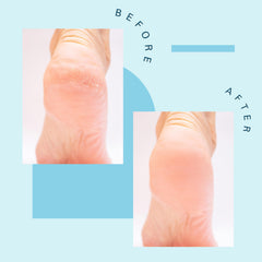 M3 Naturals Foot Soak helps dry cracked skin become softer after each soak.