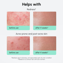 MAREE Azelaic Acid Serum on hand demonstrating lightweight hydration.